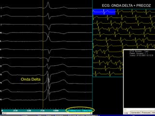 ECG: ONDA DELTA + PRECOZ




Onda Delta
 