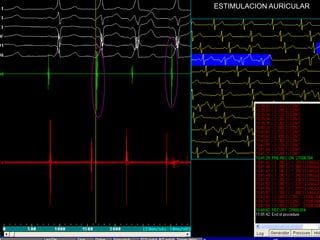 ESTIMULACION AURICULAR
 