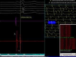 4.   LOCALIZACIÓN VÍA ACCESORIA
                             5.        APLICACIÓN RF
                                  SELECCIÓN PUNTO DE APLICACIÓN




        ONDA DELTA



                ONDA DELTA




A

        A




            V

    V
 