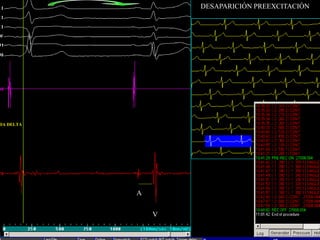 DESAPARICIÓN PREEXCITACIÓN




DA DELTA




           A


               V
 