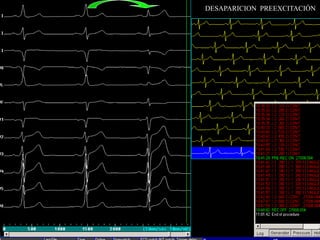 DESAPARICION PREEXCITACIÓN
 