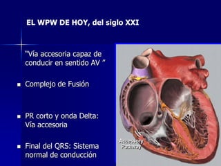 EL WPW DE HOY, del siglo XXI



    “Vía accesoria capaz de
    conducir en sentido AV ”

   Complejo de Fusión



   PR corto y onda Delta:
    Vía accesoria

   Final del QRS: Sistema
    normal de conducción
 