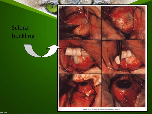 Ablasio Retina Kelompok 1