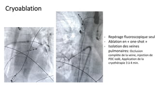 Isolated Pdc Ablation de fibrillation auriculaire | PDF