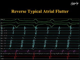 Inverted A Flutter Ablation of atypical flutter | PPTX