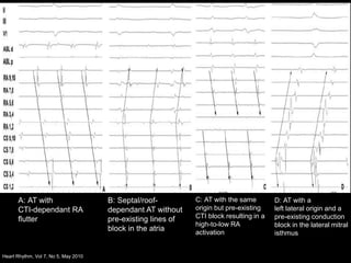 Ablation of atypical flutter | PPTX