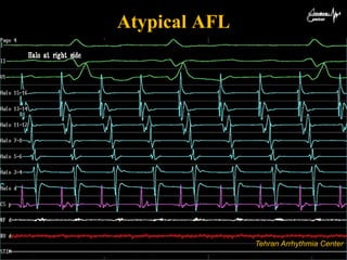 Ablation of atypical flutter | PPTX