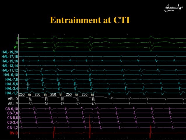 cti ablation flutter cti ablation flutter