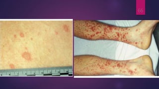 Rocky Mountain spotted fever rash
66
 