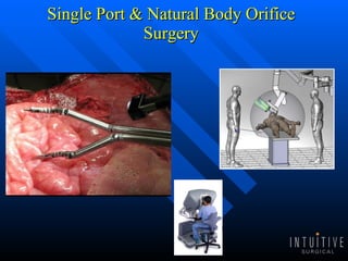 Single Port & Natural Body Orifice Surgery 