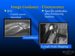 Image Guidance - Fluorescence ICG Central venous Interstitial Specific antibodies plus fluorescing markers Vasculature Lymph Node Mapping 