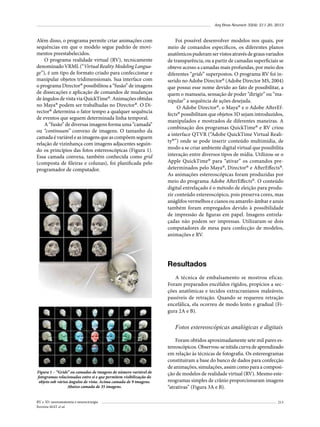 Arq Bras Neurocir 32(4): 211-20, 2013

Além disso, o programa permite criar animações com
sequências em que o modelo segue padrão de movimentos preestabelecidos.
O programa realidade virtual (RV), tecnicamente
denominado VRML (“Virtual Reality Modeling Language”), é um tipo de formato criado para confeccionar e
manipular objetos tridimensionais. Sua interface com
o programa Director® possibilitou a “fusão” de imagens
de dissecações e aplicação de comandos de mudanças
de ângulos de vista via QuickTime®. Animações obtidas
no Maya® podem ser trabalhadas no Director®. O Director® determina o fator tempo a qualquer sequência
de eventos que seguem determinada linha temporal.
A “fusão” de diversas imagens forma uma “camada”
ou “continuum” convexo de imagens. O tamanho da
camada é variável e as imagens que as compõem seguem
relação de vizinhança com imagens adjacentes seguindo os princípios das fotos estereoscópicas (Figura 1).
Essa camada convexa, também conhecida como grid
(composta de fileiras e colunas), foi planificada pelo
programador de computador.

Foi possível desenvolver modelos nos quais, por
meio de comandos específicos, os diferentes planos
anatômicos puderam ser vistos através de graus variados
de transparência, ou a partir de camadas superficiais se
obteve acesso a camadas mais profundas, por meio dos
diferentes “grids” superpostos. O programa RV foi inserido no Adobe Director® (Adobe Director MS, 2004)
que possui esse nome devido ao fato de possibilitar, a
quem o manuseia, sensação de poder “dirigir” ou “manipular” a sequência de ações desejada.
O Adobe Director®, o Maya® e o Adobe AfterEffects® possibilitam que objetos 3D sejam introduzidos,
manipulados e mostrados de diferentes maneiras. A
combinação dos programas QuickTime® e RV criou
a interface QTVR (“Adobe QuickTime Virtual Reality®”) onde se pode inserir conteúdo multimídia, de
modo a se criar ambiente digital virtual que possibilita
interação entre diversos tipos de mídia. Utilizou-se o
Apple QuickTime® para “ativar” os comandos predeterminados pelo Maya®, Director® e AfterEffects®.
As animações estereoscópicas foram produzidas por
meio do programa Adobe AfterEffects®. O conteúdo
digital entrelaçado é o método de eleição para produzir conteúdo estereoscópico, pois preserva cores, mas
anáglifos vermelhos e cianos ou amarelo-âmbar e azuis
também foram empregados devido à possibilidade
de impressão de figuras em papel. Imagens entrelaçadas não podem ser impressas. Utilizaram-se dois
computadores de mesa para confecção de modelos,
animações e RV.

Resultados
A técnica de embalsamento se mostrou eficaz.
Foram preparados encéfalos rígidos, propícios a secções anatômicas e tecidos extracranianos maleáveis,
passíveis de retração. Quando se requereu retração
encefálica, ela ocorreu de modo lento e gradual (Figura 2A e B).

Fotos estereoscópicas analógicas e digitais

Figura 1 – “Grids” ou camadas de imagens de número variável de
fotogramas relacionadas entre si e que permitem visibilização do
objeto sob vários ângulos de vista. Acima camada de 9 imagens.
Abaixo camada de 35 imagens.
RV e 3D: neuroanatomia e neurocirurgia
Ferreira MAT et al.

Foram obtidos aproximadamente sete mil pares estereoscópicos. Observou-se nítida curva de aprendizado
em relação às técnicas de fotografia. Os estereogramas
constituíram a base do banco de dados para confecção
de animações, simulações, assim como para a composição de modelos de realidade virtual (RV). Mesmo estereogramas simples de crânio proporcionaram imagens
“atrativas” (Figura 3A e B).
213

 