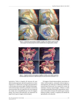Arq Bras Neurocir 32(4): 211-20, 2013

Figura 4 – Fotogramas estereoscópicos anáglifos vermelhos-ciano obtidos a partir de vídeo
estereoscópico com demonstração do acesso translabiríntico ao ângulo ponto-cerebelar.

Figura 5 – Sequência de fotos estereoscópicas anáglifas vermelhas-ciano obtidas a partir de
animação digital que demonstra os diferentes passos de uma das técnicas de fixação C1-C2.

operatório. Todos os ângulos de interesse de uma
determinada exposição operatória puderam ser vistos
(Figuras 6 e 7). Obtiveram-se sempre vista panorâmica
e microscópica da mesma região. Modelo semitransparente estereoscópico interativo contendo as estruturas
neurovasculares das três superfícies do osso temporal
foi criado, mas é exemplificado por meio de imagens
planas. Por motivo desconhecido, sua impressão em
papel não fez gerar imagem estereoscópica.
RV e 3D: neuroanatomia e neurocirurgia
Ferreira MAT et al.

Às imagens virtuais estereoscópicas, associaram-se
vídeos estereoscópicos, animações estereoscópicas e
estereogramas, de modo que os diferentes métodos de
estereoscopia forneceram rico material de ensino de
anatomia e técnica neurocirúrgica. Utilizou-se ainda
conteúdo multimídia (ilustrações esquemáticas, narrações e textos sobre os temas), de maneira que o usuário
pudesse escolher o modo e a sequência do método de
aprendizado a ele oferecido.
215

 