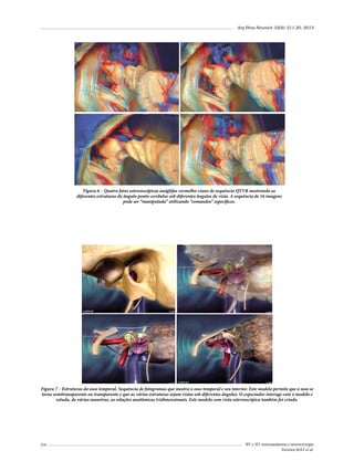 Arq Bras Neurocir 32(4): 211-20, 2013

Figura 6 – Quatro fotos estereoscópicas anáglifas vermelho-ciano de sequência QTVR mostrando as
diferentes estruturas do ângulo ponto-cerebelar sob diferentes ângulos de vista. A sequência de 16 imagens
pode ser “manipulada” utilizando “comandos” específicos.

Figura 7 – Estruturas do osso temporal. Sequência de fotogramas que mostra o osso temporal e seu interior. Este modelo permite que o osso se
torne semitransparente ou transparente e que as várias estruturas sejam vistas sob diferentes ângulos. O expectador interage com o modelo e
estuda, de várias maneiras, as relações anatômicas tridimensionais. Este modelo com vista estereoscópica também foi criado.

216

RV e 3D: neuroanatomia e neurocirurgia
Ferreira MAT et al.

 