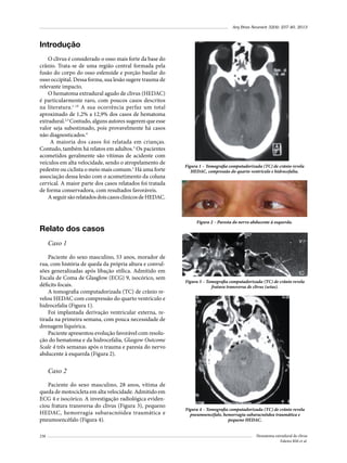 Arq Bras Neurocir 32(4): 237-40, 2013

Introdução
O clivus é considerado o osso mais forte da base do
crânio. Trata-se de uma região central formada pela
fusão do corpo do osso esfenoide e porção basilar do
osso occipital. Dessa forma, sua lesão sugere trauma de
relevante impacto.
O hematoma extradural agudo de clivus (HEDAC)
é particularmente raro, com poucos casos descritos
na literatura.1-18 A sua ocorrência perfaz um total
aproximado de 1,2% a 12,9% dos casos de hematoma
extradural.2,3 Contudo, alguns autores sugerem que esse
valor seja subestimado, pois provavelmente há casos
não diagnosticados.4
A maioria dos casos foi relatada em crianças.
Contudo, também há relatos em adultos.3 Os pacientes
acometidos geralmente são vítimas de acidente com
veículos em alta velocidade, sendo o atropelamento de
pedestre ou ciclista o meio mais comum.1 Há uma forte
associação dessa lesão com o acometimento da coluna
cervical. A maior parte dos casos relatados foi tratada
de forma conservadora, com resultados favoráveis.
A seguir são relatados dois casos clínicos de HEDAC.

Relato dos casos

Figura 1 – Tomografia computadorizada (TC) de crânio revela
HEDAC, compressão do quarto ventrículo e hidrocefalia.

Figura 2 – Paresia do nervo abducente à esquerda.

Caso 1
Paciente do sexo masculino, 53 anos, morador de
rua, com história de queda da própria altura e convulsões generalizadas após libação etílica. Admitido em
Escala de Coma de Glasglow (ECG) 9, isocórico, sem
déficits focais.
A tomografia computadorizada (TC) de crânio revelou HEDAC com compressão do quarto ventrículo e
hidrocefalia (Figura 1).
Foi implantada derivação ventricular externa, retirada na primeira semana, com pouca necessidade de
drenagem liquórica.
Paciente apresentou evolução favorável com resolução do hematoma e da hidrocefalia, Glasgow Outcome
Scale 4 três semanas após o trauma e paresia do nervo
abducente à esquerda (Figura 2).

Figura 3 – Tomografia computadorizada (TC) de crânio revela
fratura transversa de clivus (setas).

Caso 2
Paciente do sexo masculino, 28 anos, vítima de
queda de motocicleta em alta velocidade. Admitido em
ECG 4 e isocórico. A investigação radiológica evidenciou fratura transversa do clivus (Figura 3), pequeno
HEDAC, hemorragia subaracnóidea traumática e
pneumoencéfalo (Figura 4).
238

Figura 4 – Tomografia computadorizada (TC) de crânio revela
pneumoencéfalo, hemorragia subaracnóidea traumática e
pequeno HEDAC.
Hematoma extradural de clivus
Faleiro RM et al.

 
