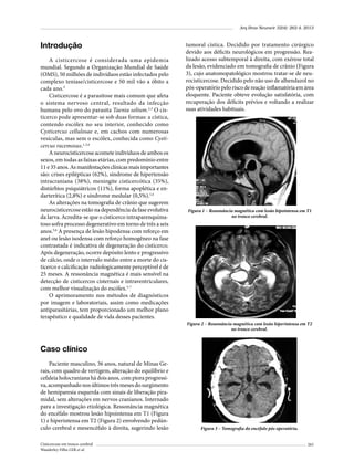 Arq Bras Neurocir 32(4): 262-4, 2013

Introdução
A cisticercose é considerada uma epidemia
mundial. Segundo a Organização Mundial de Saúde
(OMS), 50 milhões de indivíduos estão infectados pelo
complexo teníase/cisticercose e 50 mil vão a óbito a
cada ano.¹
Cisticercose é a parasitose mais comum que afeta
o sistema nervoso central, resultado da infecção
humana pelo ovo do parasita Taenia solium.2,3 O cisticerco pode apresentar-se sob duas formas: a cística,
contendo escólex no seu interior, conhecido como
Cysticercus cellulosae e, em cachos com numerosas
vesículas, mas sem o escólex, conhecida como Cysticercus racemosus.1,3,4
A neurocisticercose acomete indivíduos de ambos os
sexos, em todas as faixas etárias, com predomínio entre
11 e 35 anos. As manifestações clínicas mais importantes
são: crises epilépticas (62%), síndrome de hipertensão
intracraniana (38%), meningite cisticercótica (35%),
distúrbios psiquiátricos (11%), forma apoplética e endarterítica (2,8%) e síndrome medular (0,5%).1,4
As alterações na tomografia de crânio que sugerem
neurocisticercose estão na dependência da fase evolutiva
da larva. Acredita-se que o cisticerco intraparenquimatoso sofra processo degenerativo em torno de três a seis
anos.5,6 A presença de lesão hipodensa com reforço em
anel ou lesão isodensa com reforço homogêneo na fase
contrastada é indicativa de degeneração do cisticerco.
Após degeneração, ocorre depósito lento e progressivo
de cálcio, onde o intervalo médio entre a morte do cisticerco e calcificação radiologicamente perceptível é de
25 meses. A ressonância magnética é mais sensível na
detecção de cisticercos cisternais e intraventriculares,
com melhor visualização do escólex.5-7
O aprimoramento nos métodos de diagnósticos
por imagem e laboratoriais, assim como medicações
antiparasitárias, tem proporcionado um melhor plano
terapêutico e qualidade de vida desses pacientes.

tumoral cística. Decidido por tratamento cirúrgico
devido aos déficits neurológicos em progressão. Realizado acesso subtemporal à direita, com exérese total
da lesão, evidenciado em tomografia de crânio (Figura
3), cujo anatomopatológico mostrou tratar-se de neurocisticercose. Decidido pelo não uso de albendazol no
pós-operatório pelo risco de reação inflamatória em área
eloquente. Paciente obteve evolução satisfatória, com
recuperação dos déficits prévios e voltando a realizar
suas atividades habituais.

Figura 1 – Ressonância magnética com lesão hipointensa em T1
no tronco cerebral.

Figura 2 – Ressonância magnética com lesão hiperintensa em T2
no tronco cerebral.

Caso clínico
Paciente masculino, 36 anos, natural de Minas Gerais, com quadro de vertigem, alteração do equilíbrio e
cefaleia holocraniana há dois anos, com piora progressiva, acompanhado nos últimos três meses do surgimento
de hemiparesia esquerda com sinais de liberação piramidal, sem alterações em nervos cranianos. Internado
para a investigação etiológica. Ressonância magnética
do encéfalo mostrou lesão hipointensa em T1 (Figura
1) e hiperintensa em T2 (Figura 2) envolvendo pedúnculo cerebral e mesencéfalo à direita, sugerindo lesão
Cisticercose em tronco cerebral
Wanderley Filho LER et al.

Figura 3 – Tomografia do encéfalo pós-operatória.
263

 