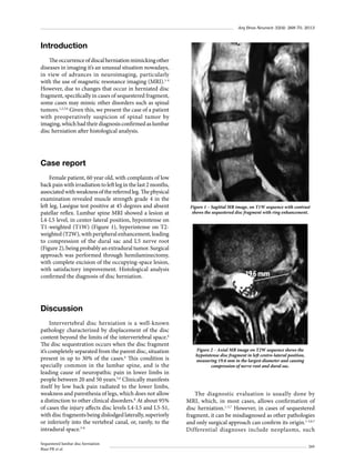 Arq Bras Neurocir 32(4): 268-70, 2013

Introduction
The occurrence of discal herniation mimicking other
diseases in imaging it’s an unusual situation nowadays,
in view of advances in neuroimaging, particularly
with the use of magnetic resonance imaging (MRI).1-4
However, due to changes that occur in herniated disc
fragment, specifically in cases of sequestered fragment,
some cases may mimic other disorders such as spinal
tumors.1,2,5,6 Given this, we present the case of a patient
with preoperatively suspicion of spinal tumor by
imaging, which had their diagnosis confirmed as lumbar
disc herniation after histological analysis.

Case report
Female patient, 60 year old, with complaints of low
back pain with irradiation to left leg in the last 2 months,
associated with weakness of the referred leg. The physical
examination revealed muscle strength grade 4 in the
left leg, Laségue test positive at 45 degrees and absent
patellar reflex. Lumbar spine MRI showed a lesion at
L4-L5 level, in center-lateral position, hypointense on
T1-weighted (T1W) (Figure 1), hyperintense on T2weighted (T2W), with peripheral enhancement, leading
to compression of the dural sac and L5 nerve root
(Figure 2), being probably an extradural tumor. Surgical
approach was performed through hemilaminectomy,
with complete excision of the occupying-space lesion,
with satisfactory improvement. Histological analysis
confirmed the diagnosis of disc herniation.

Figure 1 – Sagittal MR image, on T1W sequence with contrast
shows the sequestered disc fragment with ring enhancement.

Discussion
Intervertebral disc herniation is a well-known
pathology characterized by displacement of the disc
content beyond the limits of the intervertebral space.6
The disc sequestration occurs when the disc fragment
it’s completely separated from the parent disc, situation
present in up to 30% of the cases.6 This condition is
specially common in the lumbar spine, and is the
leading cause of neuropathic pain in lower limbs in
people between 20 and 50 years.5,6 Clinically manifests
itself by low back pain radiated to the lower limbs,
weakness and paresthesia of legs, which does not allow
a distinction to other clinical disorders.6 At about 95%
of cases the injury affects disc levels L4-L5 and L5-S1,
with disc fragments being dislodged laterally, superiorly
or inferiorly into the vertebral canal, or, rarely, to the
intradural space.5-8
Sequestered lumbar disc herniation
Biasi PR et al.

Figure 2 – Axial MR image on T2W sequence shows the
hypointense disc fragment in left centro-lateral position,
measuring 19.6 mm in the largest diameter and causing
compression of nerve root and dural sac.

The diagnostic evaluation is usually done by
MRI, which, in most cases, allows confirmation of
disc herniation.1-5,7 However, in cases of sequestered
fragment, it can be misdiagnosed as other pathologies
and only surgical approach can confirm its origin.1-3,6,7
Differential diagnoses include neoplasms, such
269

 