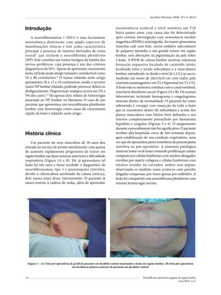 Arq Bras Neurocir 32(4): 271-4, 2013

Introdução

incontinência urofecal e nível sensitivo em T10
havia quatro anos, cuja causa não foi determinada
após extensa investigação com ressonância nuclear
magnética (RNM) e arteriografia. Ao exame apresentava
manchas café com leite, vários nódulos subcutâneos
de pequeno tamanho e um grande tumor em região
lombar, sem alterações na pigmentação da pele sobre
a lesão. A RNM de coluna lombar mostrou volumosa
formação expansiva loculada de conteúdo misto,
localizada entre o tecido subcutâneo e a musculatura
lombar, estendendo-se desde o nível de L1/L2 ao sacro,
medindo em torno de 20x13x10 cm com realce pelo
contraste paramagnético em T1 e hipersinal em T1 e T2.
A lesão não se mostrava contínua com o canal vertebral,
mas havia disrafismo sacral (Figura 2A e B). Os exames
laboratoriais incluindo hemograma e coagulograma
estavam dentro da normalidade. O paciente foi então
submetido à cirurgia com ressecção de toda a lesão
que se encontrava abaixo do subcutâneo e acima dos
planos musculares com limites bem definidos e seu
interior completamente preenchido por hematoma
liquefeito e coágulos (Figuras 3 e 4). O sangramento
durante o procedimento não foi significativo. O paciente
recebeu alta hospitalar cerca de três semanas depois,
após estabilização de sua condição respiratória, uma
vez que ele apresentou piora transitória da pneumopatia
restritiva no pós-operatório. A anatomia patológica
mostrou tratar-se de lesão contendo proliferação celular
composta por células fusiformes com núcleos alongados
envoltas por matriz colágena e células fusiformes com
núcleos ovoides ou curvados, ambos sem atipias,
observando-se também vasos ectásicos com paredes
delgadas compostas, por vezes apenas por endotélio. A
lesão foi compatível com neurofibroma plexiforme com
extensa hemorragia recente.

A neurofibromatose 1 (NF1) é uma facomatose
autossômica dominante com amplo espectro de
manifestações clínicas e tem como característica
principal a presença de tumores derivados da crista
neural¹ que incluem o neurofibroma plexiforme
(NP). Este constitui um tumor benigno da bainha dos
nervos periféricos, cuja presença é um dos critérios
diagnósticos de NF1. Apesar de apresentar crescimento
lento, tal lesão pode atingir tamanho considerável como
70 x 80 centímetros.² O tumor relatado neste artigo
apresentava 20 x 13 x 10 centímetros, sendo o terceiro
maior NP lombar relatado, podendo provocar déficit ou
desfiguramento. Degeneração maligna ocorre em 2% a
5% dos casos.2,3 Há apenas dois relatos de hemorragia
associada ao NP lombar na literatura. O caso de um
paciente que apresentou um neurofibroma plexiforme
lombar com hemorragia como causa do crescimento
rápido da lesão é relatado neste artigo.

História clínica
Um paciente do sexo masculino de 30 anos deu
entrada no serviço de pronto atendimento com queixa
de aumento rapidamente progressivo de tumor em
região lombar nas duas semanas anteriores e dificuldade
respiratória (Figura 1A e B). Ele já apresentava tal
lesão há três anos e havia recebido o diagnóstico de
neurofibromatose tipo 1 e pneumopatia restritiva,
devido à cifoescoliose acentuada da coluna torácica,
dois meses antes desse internamento. O paciente já
estava restrito à cadeira de rodas, além de apresentar

A

B

Figura 1 – (A) Foto pré-operatória de perfil do paciente em decúbito ventral mostrando a lesão em região lombar. (B) Foto pré-operatória
em incidência póstero-anterior do paciente em decúbito ventral.
272

Neurofibroma plexiforme gigante da região lombar
Lima MDC et al.

 
