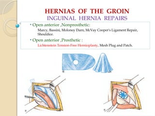 HERNIAS OF THE GROIN
INGUINAL HERNIA REPAIRS
• Open anterior ,Nonprosthetic:
Marcy, Bassini, Moloney Darn, McVay Cooper's Ligament Repair,
Shouldice.
• Open anterior ,Prosthetic :
Lichtenstein Tension-Free Hernioplasty, Mesh Plug and Patch.
 