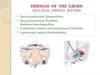 HERNIAS OF THE GROIN
INGUINAL HERNIA REPAIRS
 Open preperitoneal, Nonprosthetic.
 Open preperitoneal, Prosthetic:
Read-Rives, Wantz/Stoppa/Rives.
 Combination anterior and preperitoneal, Prosthetic.
 Laparoscopic inguinal herniorrhaphy.
 