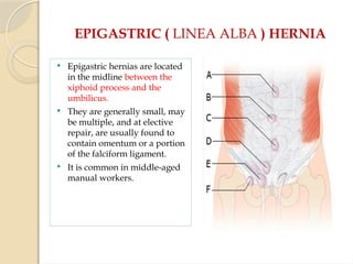 EPIGASTRIC ( LINEA ALBA ) HERNIA
 Epigastric hernias are located
in the midline between the
xiphoid process and the
umbilicus.
 They are generally small, may
be multiple, and at elective
repair, are usually found to
contain omentum or a portion
of the falciform ligament.
 It is common in middle-aged
manual workers.
 