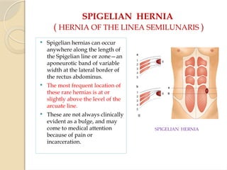 SPIGELIAN HERNIA
( HERNIA OF THE LINEA SEMILUNARIS )
 Spigelian hernias can occur
anywhere along the length of
the Spigelian line or zone—an
aponeurotic band of variable
width at the lateral border of
the rectus abdominus.
 The most frequent location of
these rare hernias is at or
slightly above the level of the
arcuate line.
 These are not always clinically
evident as a bulge, and may
come to medical attention
because of pain or
incarceration.
SPIGELIAN HERNIA
 