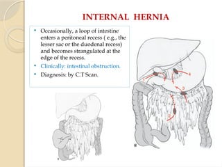 INTERNAL HERNIA
 Occasionally, a loop of intestine
enters a peritoneal recess ( e.g., the
lesser sac or the duodenal recess)
and becomes strangulated at the
edge of the recess.
 Clinically: intestinal obstruction.
 Diagnosis: by C.T Scan.
 