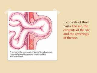 It consists of three
parts: the sac, the
contents of the sac,
and the coverings
of the sac.
A hernia is the protrusion of part of the abdominal
contents beyond the normal confines of the
abdominal wall .
 
