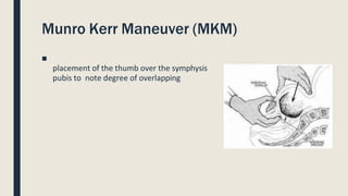 Munro Kerr Maneuver (MKM)
■
placement of the thumb over the symphysis
pubis to note degree of overlapping
 