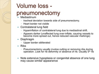 Volume loss -
pneumonectomy
   Mediastinum
    ◦ tracheal deviation towards side of pneumonectomy.
    ◦ Heart border not visible
   Contralateral lung field
    ◦ Hyperinflation of contralateral lung due to mediastinal shift.
    ◦ Appears darker (unaffected lung over-inflate, causing vessels to
      become more spread out, hence reduced vascular markings)
   Diaphragm
    ◦ Upper border obliterated
   Ribs
    ◦ Pneumonectomy usually involve cutting or removing ribs during
      operation. Look for rib deformity or absence of rib. Usually 5th rib

   Note extensive hypoplasia or congenital absence of one lung
    may cause similar appearance
 