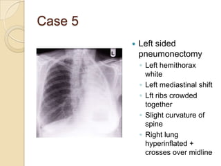 Case 5
            Left sided
             pneumonectomy
             ◦ Left hemithorax
               white
             ◦ Left mediastinal shift
             ◦ Lft ribs crowded
               together
             ◦ Slight curvature of
               spine
             ◦ Right lung
               hyperinflated +
               crosses over midline
 