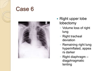 Case 6
            Right upper lobe
             lobectomy
             ◦ Volume loss of right
               lung
             ◦ Right tracheal
               deviation
             ◦ Remaining right lung
               hyperinflated, appea
               rs darker
             ◦ Right diaphragm –
               diagphragmatic
               tenting
 