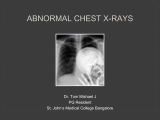 ABNORMAL CHEST X-RAYS
Dr. Tom Mishael J
PG Resident
St. John’s Medical College Bangalore
 