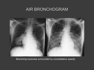 Abnormal Chest X rays | PPTX