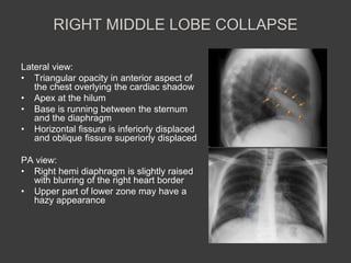 Triangular Sign Chest Abnormal Chest X rays | PPTX