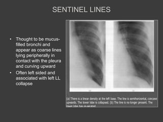 Sentinel Line Tracing Abnormal Chest X rays | PPTX