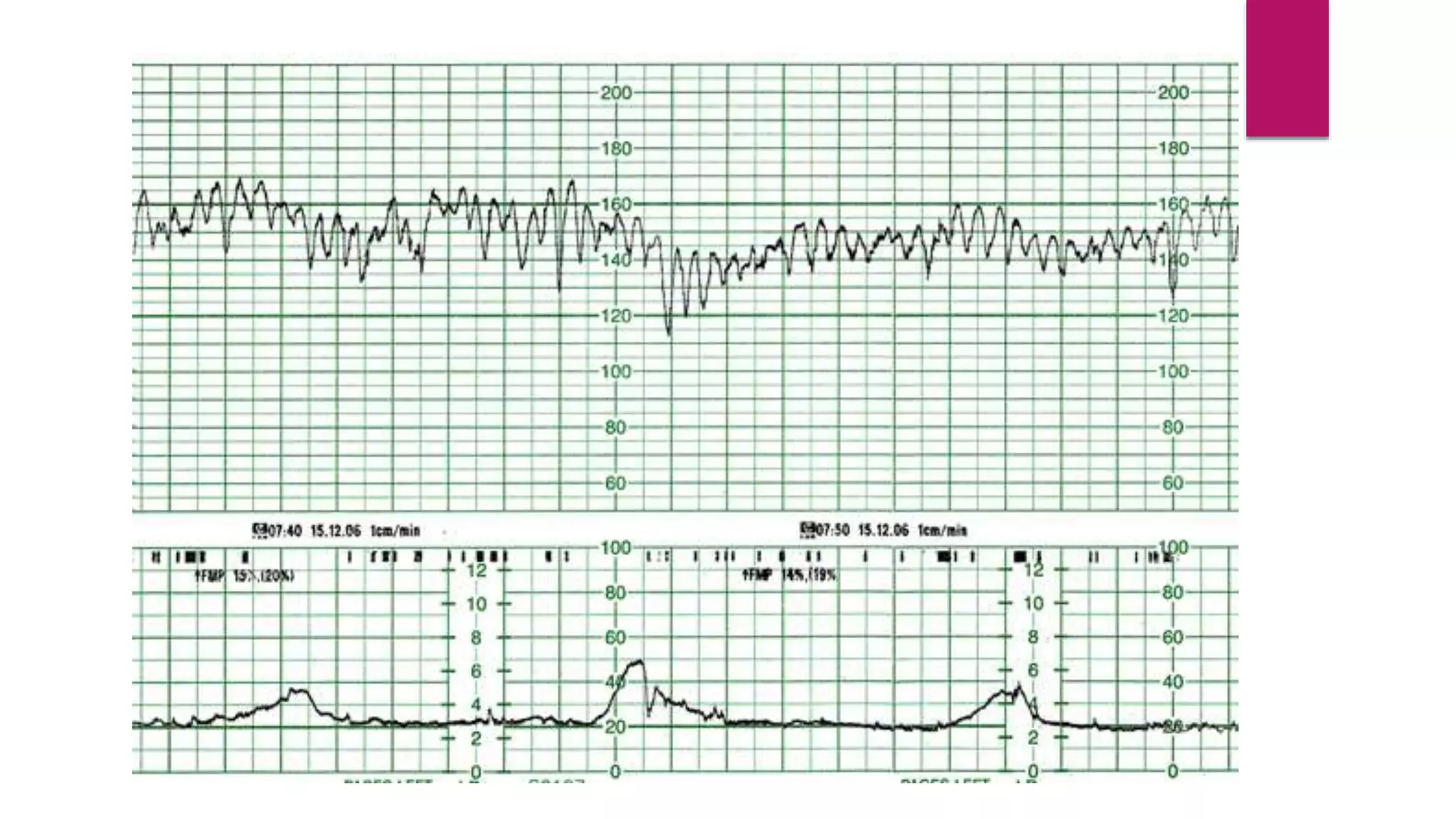 Pathologic Ctg Abnormal CTG | PPTX