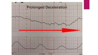Abnormal CTG | PPTX
