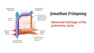 Jonathan Frimpong
Abnormal drainage of the
pulmonary veins
 