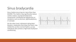 Sinus bradycardia
Sinus rhythm occurring at a rate of less than
60 BPM. This rhythm may significantly reduce
cardiac output, causing hemodynamic
compromise, manifested by hypotension or
symptoms such as dizziness, lightheadedness,
or syncope.
On the other hand, individuals taking beta-
blockers, medication that slows the heart, may
exhibit this as their normal rhythm, as may
individuals who achieve a high level of physical
conditioning.
 