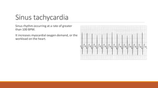Sinus tachycardia
Sinus rhythm occurring at a rate of greater
than 100 BPM.
It increases myocardial oxygen demand, or the
workload on the heart.
 