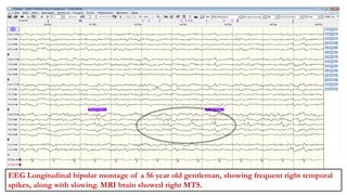 MD YOUSUF ALI(4820545)
EEG Longitudinal bipolar montage of a 56 year old gentleman, showing frequent right temporal
spikes, along with slowing. MRI brain showed right MTS.
 