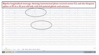 Bipolar longitudinal montage showing instrumental phase reversal across C3, and also frequent
spikes at P3 in a 36 year old lady with left parietal gliosis and seizures.
 