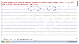 Bipolar longitudinal montage showing instrumental phase reversal across F3, in a 28 year lady
with nocturnal seizures and normal MRI brain.
 
