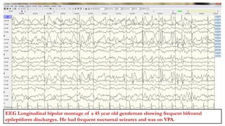 YESHRAJ SINGH-8 Y (4759113) BIFRONTAL
SPIKES
EEG Longitudinal bipolar montage of a 45 year old gentleman showing frequent bifrontal
epileptiform discharges. He had frequent nocturnal seizures and was on VPA.
 