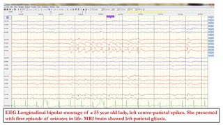 INDIRA ANAVATTI(2222355)
Focal Spikes
EEG Longitudinal bipolar montage of a 55 year old lady, left centro-parietal spikes. She presented
with first episode of seizures in life. MRI brain showed left parietal gliosis.
 