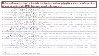 Referential montage showing frontally dominant generalised polyspike and wave discharges in a
22 year old patient with JME. Few focal frontal spikes are seen.
 