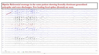 Bipolar Referential montage in the same patient showing frontally dominant generalised
polyspike and wave discharges. Few leading focal spikes (frontal) are seen.
 