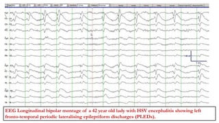 EEG Longitudinal bipolar montage of a 42 year old lady with HSV encephalitis showing left
fronto-temporal periodic lateralising epileptiform discharges (PLEDs).
 