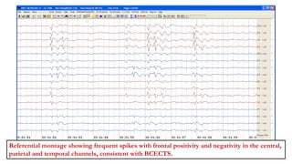 Referential montage showing frequent spikes with frontal positivity and negativity in the central,
parietal and temporal channels, consistent with BCECTS.
 